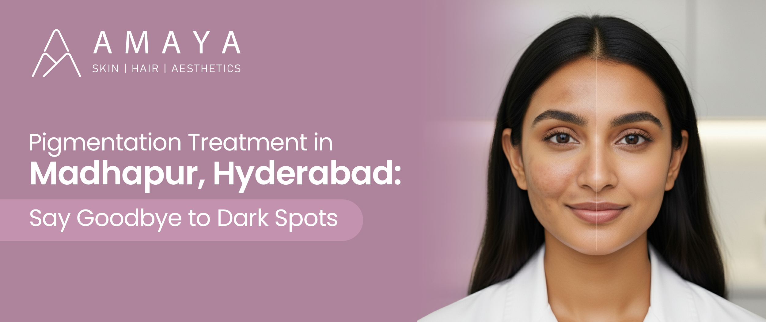 Pigmentation Treatment in Madhapur, Hyderabad: Say Goodbye to Dark Spots