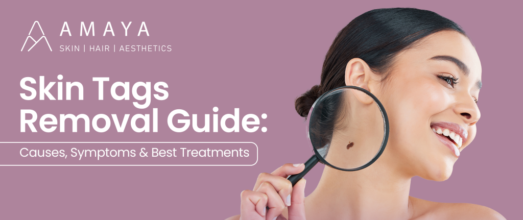 Skin Tags Removal Guide: Causes, Symptoms & Best Treatments