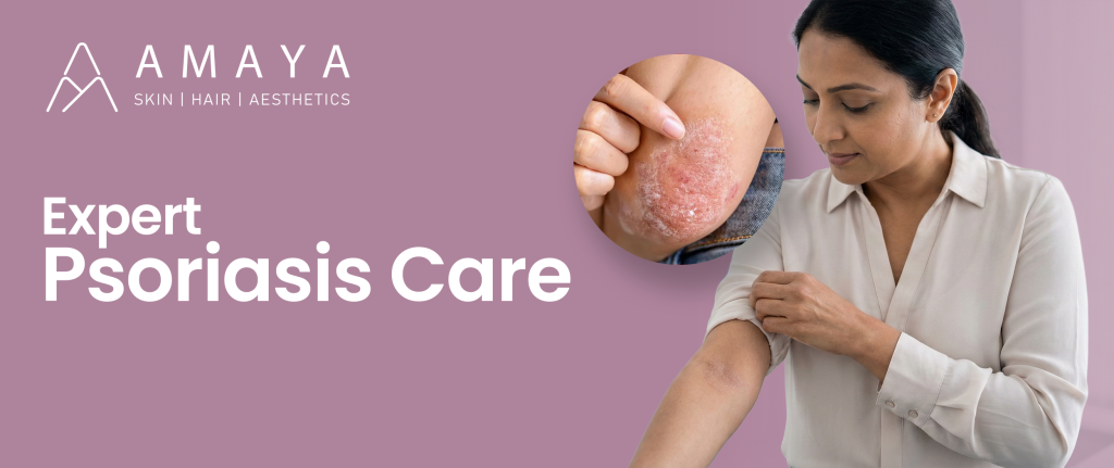 Expert Psoriasis Care by Dr. Shama Reddy at Amaya Skin, Hair & Aesthetic Clinic, Hyderabad