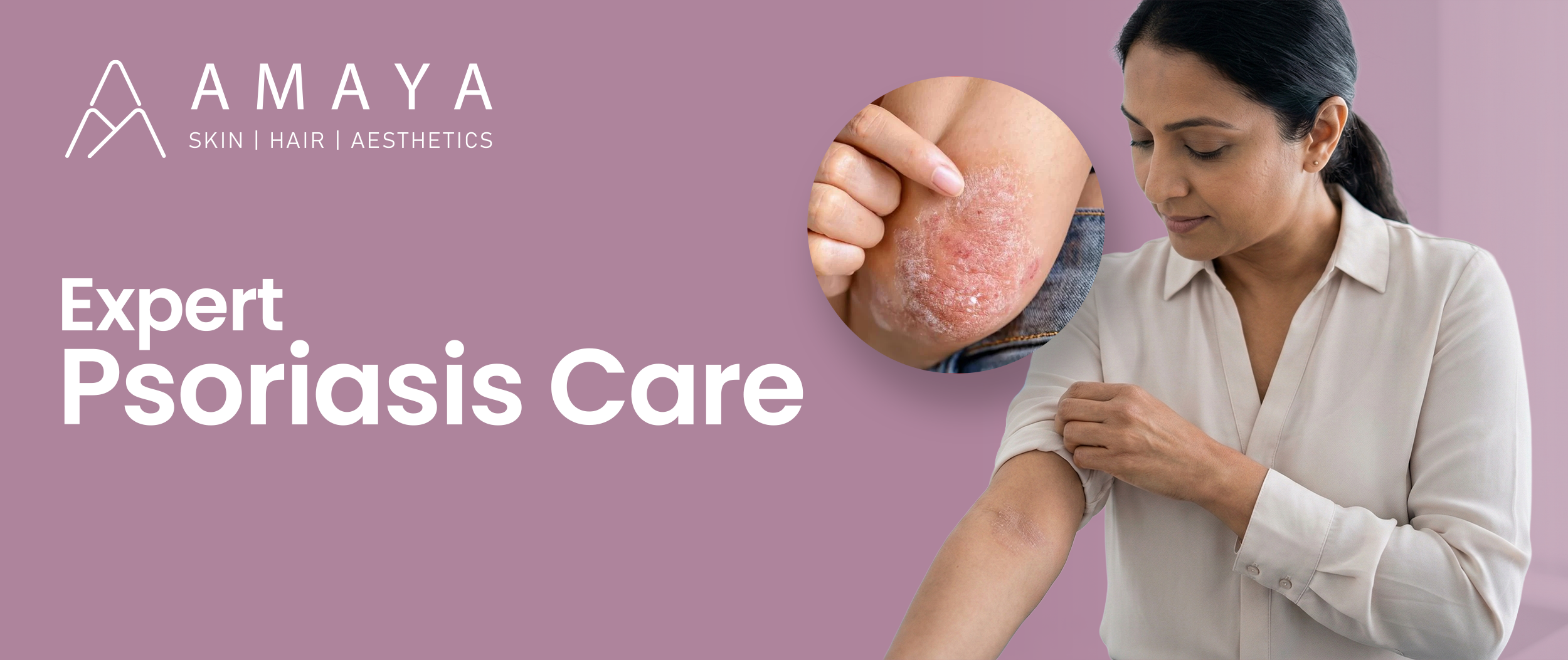 Expert Psoriasis Care by Dr. Shama Reddy at Amaya Skin, Hair & Aesthetic Clinic, Hyderabad
