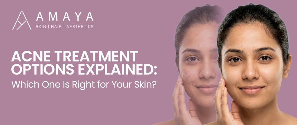 Acne Treatment Options Explained: Which One Is Right for Your Skin?