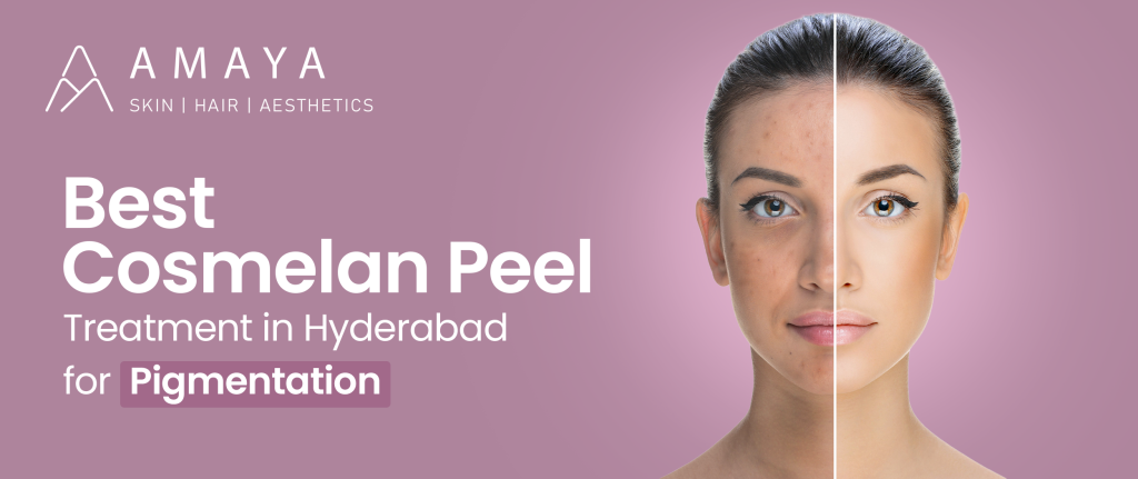 Best Cosmelan Peel Treatment in Hyderabad for Pigmentation