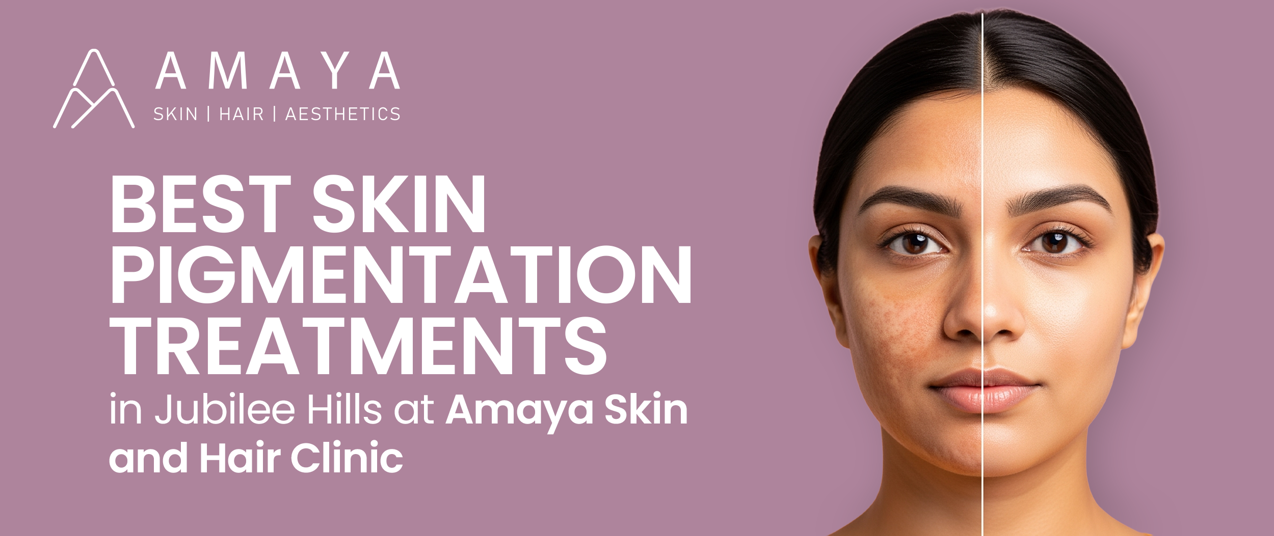 Best Skin Pigmentation Treatments in Jubilee Hills at Amaya Skin and Hair Clinic