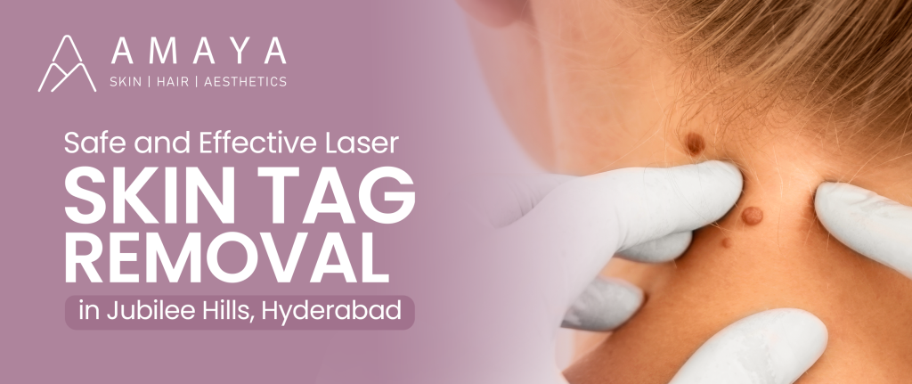 Safe and Effective Laser Skin Tag Removal in Jubilee Hills, Hyderabad