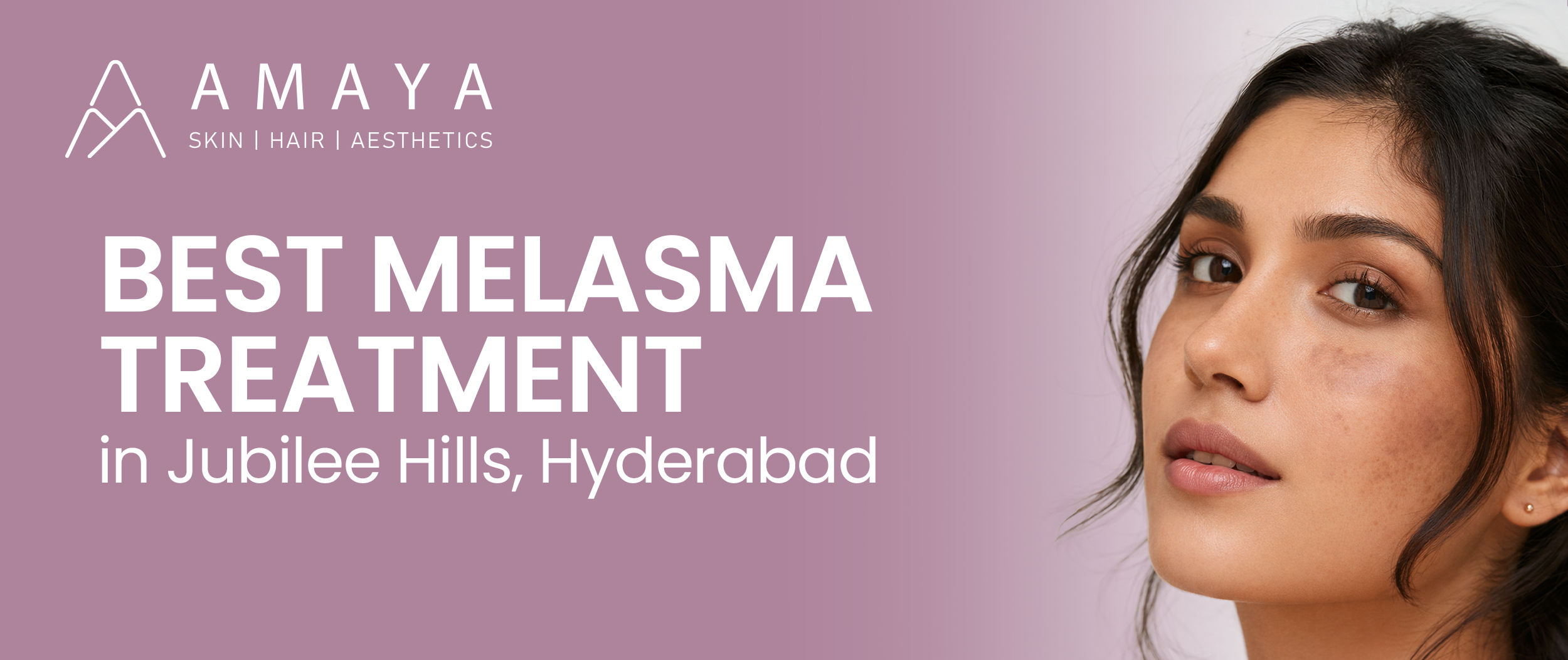 Best Melasma Treatment in Jubilee Hills, Hyderabad