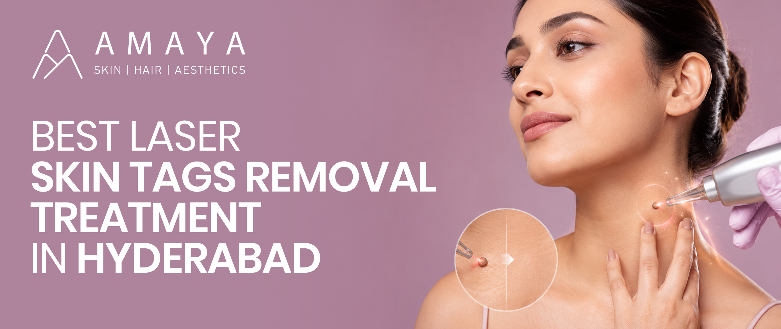 Best Laser Skin Tags Removal Treatment in Hyderabad – Amaya Skin and Hair Clinic