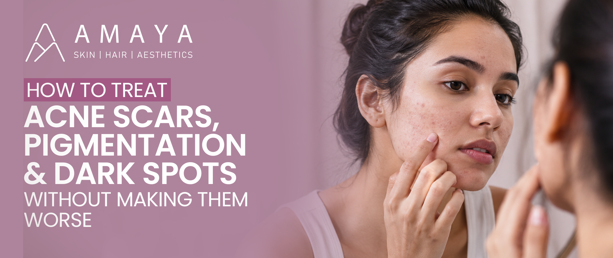 How to Treat Acne Scars, Pigmentation and Dark Spots Without Making Them Worse